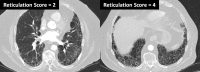 Scoring of reticulation on two axial CT images at different levels.