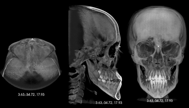 Figure 1. Identification of the nasion landmark (N) using the visualization of 3D reconstruction images.