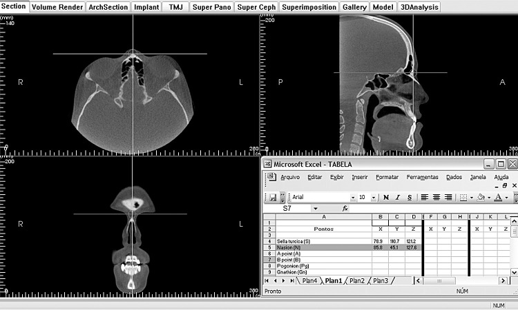 Figure 2. Identification of the nasion landmark (N) using the multiplanar views.