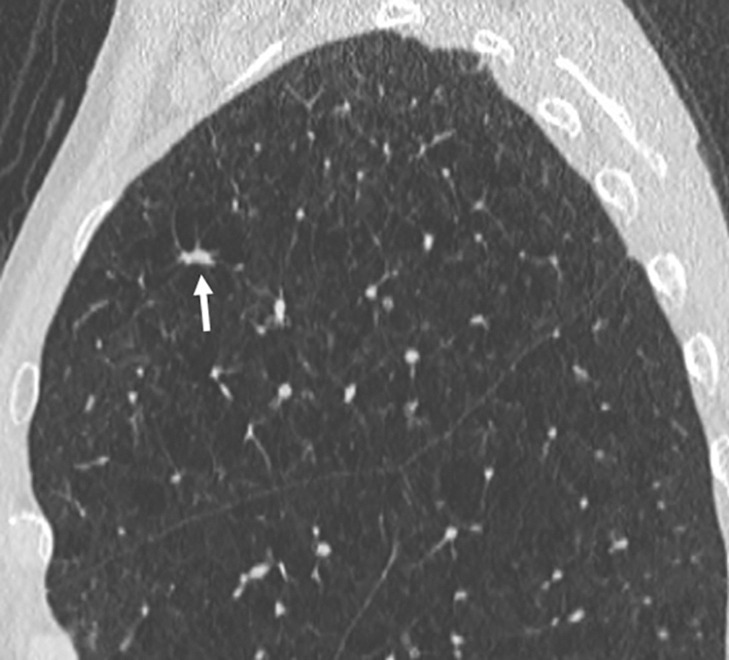 Images show lung cancer screening CT scan in 66-year-old woman. (a) Axial, (b) coronal, and (c) sagittal images show right upper-lobe nodule (arrow) classified as Lung CT Screening Reporting and Data System (Lung-RADS) category 3 nodule by one reader using manual measurements, as Lung-RADS 4A nodule by two readers using manual measurements, and as Lung-RADS 3 nodule by all three readers using volumetry. Manual average diameter is 7 mm as measured by one reader, 8 mm as measured by one reader, and 9 mm as measured by one reader; semiautomated average diameter is 7 mm as measured by two readers and 8 mm as measured by one reader; and semiautomated volume is 122 mm3 as measured by two readers and 133 mm3 as measured by one reader. Nodule remains stable on surveillance scans through 3 years of follow-up.