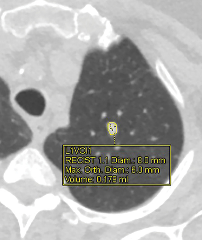 CT image shows solid left upper-lobe nodule with volumetric software processing. Display graphics include nodule margins outlined by software, location of longest and perpendicular dimensions, and corresponding linear and volume measurements. Diam = diameter; L1VOl1 = location 1, volume 1; Max = maximum; Orth = orthogonal; RECIST = Response Evaluation Criteria in Solid Tumors.