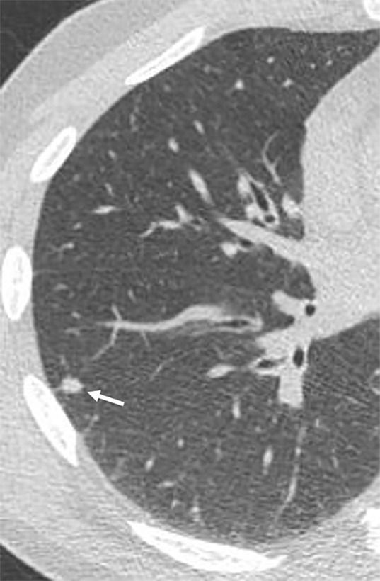 Images show lung cancer screening CT scan in 57-year-old man. (a) Axial and (b) coronal images show right lower-lobe nodule (arrow) classified as Lung CT Screening Reporting and Data System (Lung-RADS) category 3 nodule by all readers using manual measurements and as Lung-RADS 2 nodule by all readers using volumetry. Manual average diameter is 7 mm as measured by two readers and 6 mm as measured by one reader; semiautomated average diameter is 6 mm as measured by two readers and 7 mm as measured by one reader; and semiautomated volume is 91 mm3, 96 mm3, and 99 mm3 as measured by each of three readers. Note the relatively flat nonspherical shape in b. Nodule remains stable on subsequent scans up to 2.5 years later.