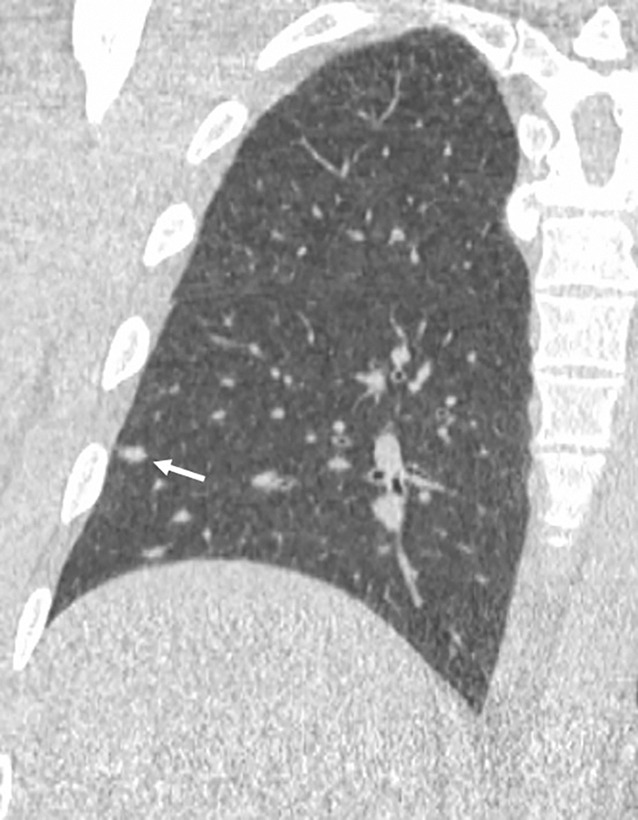 Images show lung cancer screening CT scan in 57-year-old man. (a) Axial and (b) coronal images show right lower-lobe nodule (arrow) classified as Lung CT Screening Reporting and Data System (Lung-RADS) category 3 nodule by all readers using manual measurements and as Lung-RADS 2 nodule by all readers using volumetry. Manual average diameter is 7 mm as measured by two readers and 6 mm as measured by one reader; semiautomated average diameter is 6 mm as measured by two readers and 7 mm as measured by one reader; and semiautomated volume is 91 mm3, 96 mm3, and 99 mm3 as measured by each of three readers. Note the relatively flat nonspherical shape in b. Nodule remains stable on subsequent scans up to 2.5 years later.