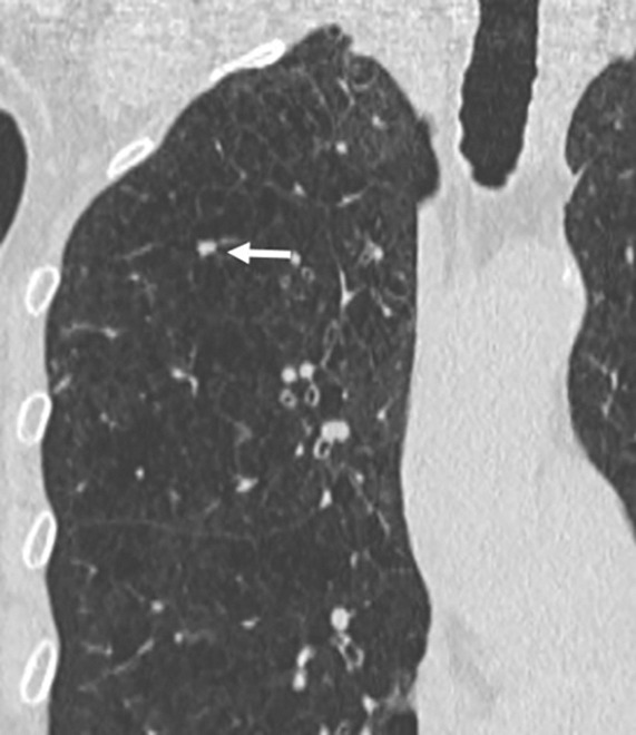 Images show lung cancer screening CT scan in 66-year-old woman. (a) Axial, (b) coronal, and (c) sagittal images show right upper-lobe nodule (arrow) classified as Lung CT Screening Reporting and Data System (Lung-RADS) category 3 nodule by one reader using manual measurements, as Lung-RADS 4A nodule by two readers using manual measurements, and as Lung-RADS 3 nodule by all three readers using volumetry. Manual average diameter is 7 mm as measured by one reader, 8 mm as measured by one reader, and 9 mm as measured by one reader; semiautomated average diameter is 7 mm as measured by two readers and 8 mm as measured by one reader; and semiautomated volume is 122 mm3 as measured by two readers and 133 mm3 as measured by one reader. Nodule remains stable on surveillance scans through 3 years of follow-up.