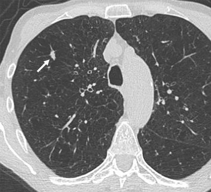 Images show lung cancer screening CT scan in 66-year-old woman. (a) Axial, (b) coronal, and (c) sagittal images show right upper-lobe nodule (arrow) classified as Lung CT Screening Reporting and Data System (Lung-RADS) category 3 nodule by one reader using manual measurements, as Lung-RADS 4A nodule by two readers using manual measurements, and as Lung-RADS 3 nodule by all three readers using volumetry. Manual average diameter is 7 mm as measured by one reader, 8 mm as measured by one reader, and 9 mm as measured by one reader; semiautomated average diameter is 7 mm as measured by two readers and 8 mm as measured by one reader; and semiautomated volume is 122 mm3 as measured by two readers and 133 mm3 as measured by one reader. Nodule remains stable on surveillance scans through 3 years of follow-up.