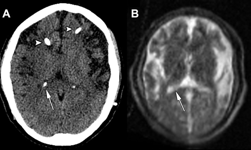 Images in a 42-year-old woman admitted for headaches with a history of congenital hydrocephalus after ventriculoperitoneal shunt placement. (A) Axial head CT scan without contrast shows no significant hydrocephalus at the level of the lateral ventricle atrium (arrow) and partially visualized ventriculostomy catheters (arrowheads). (B) Point-of-care brain MRI scan without contrast obtained with T2-weighted sequence 1 hour after axial head CT and on a similar level shows nonenlarged lateral ventricles at the level of the lateral ventricle atrium (arrow), and the ventriculostomy catheters are more difficult to visualize.