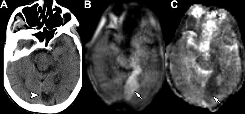 Images in an 84-year-old woman admitted for new facial droop with a history of partial left posterior cerebral artery territory infarction. (A) Axial head CT scan without contrast shows a chronic left posterior cerebral artery infarction (arrowhead). (B, C) Point-of-care brain MRI scans without contrast obtained in the axial plane 1 day later with (B) diffusion-weighted imaging and (C) apparent diffusion coefficient imaging show an acute left posterior cerebral artery territory infarction (arrows) anterior to the area of chronic infarction demonstrated on earlier head CT scans.