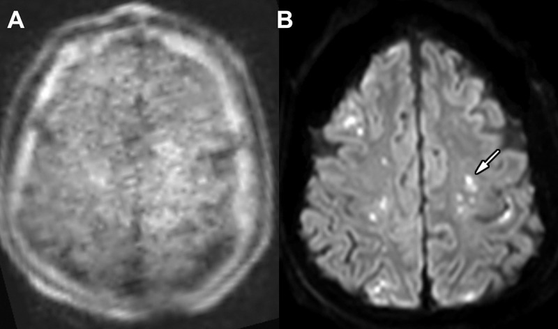 Images in an 89-year-old woman admitted for multiple injuries following a motor vehicle collision. (A) Point-of-care brain MRI scan without contrast obtained in the axial plane with diffusion-weighted imaging shows no significant abnormality. (B) Brain MRI scan without contrast obtained in the axial plane 1 day later with a fixed 3-T scanner and diffusion-weighted imaging shows punctate acute infarctions involving the bilateral centrum semiovale (arrow, left-sided involvement).