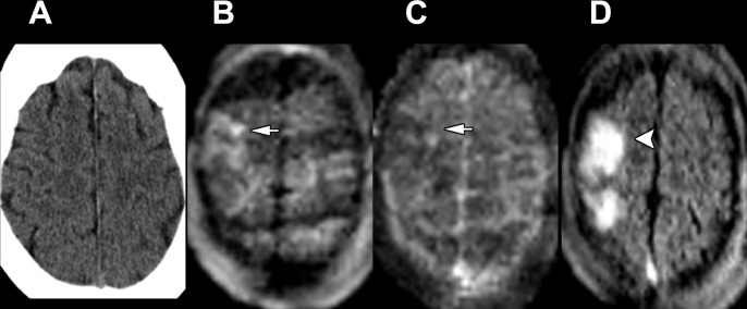 Images in a 74-year-old woman admitted for left-sided weakness and right gaze preference. (A) Axial head CT scan without contrast shows no significant abnormality. (B–D) Point-of-care brain MRI scans without contrast obtained in the axial plane 2 days later with (B) diffusion-weighted imaging, (C) apparent diffusion coefficient imaging, and (D) T2-weighted fluid-attenuated inversion recovery imaging show a right middle cerebral artery territory acute infarction with restricted diffusion (arrows) and associated T2-weighted fluid-attenuated inversion recovery signal abnormality (arrowhead).