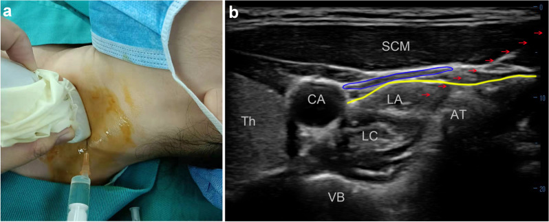 Stellate Ganglion Block As An Intervention In Refractory Eosinophilic 