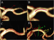 Four-panel image showing blood vessels with different annotations. Panel A has several red labels marked M1, M2, E, and lines indicating intersections. Panels B and C display a highlighted curved vessel section in red. Panel D shows the red, green, and yellow lines indicate where the slice was placed at the time of measurement, not the direction of blood flow.