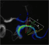 Medical imaging scan with colored annotations on a tubular structure. Three sections are marked: EL 1 in red, EL 2 in green, and EL 3 in yellow. Sections A, B, and C are indicated with white lines for reference.