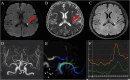 MRI images labeled A, B, and C show different brain scans with red arrows indicating specific areas. Image D displays a 3D angiography of cerebral vessels. Image E illustrates a color-coded flow map of blood circulation. Image F is a line graph with three color-coded lines representing different measurements or data over time.