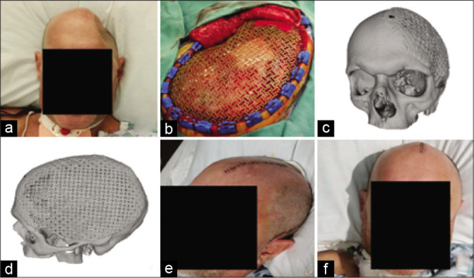 Rapid high-fidelity contour shaping of titanium mesh implants for ...