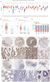 Figure 1. eIF4A1 is upregulated in gastric cancer tissues. (A) Pan–cancer analysis of eIF4A1 expression was performed using UALCAN. (B) Expression of eIF4A1 in gastric cancer tissues and in peripheral...
