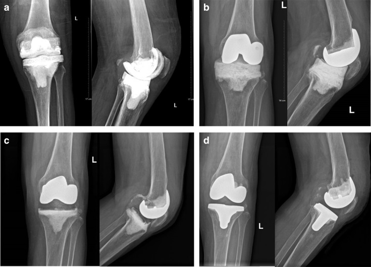 Prosthetic spacers in two-stage revision for knee periprosthetic joint ...