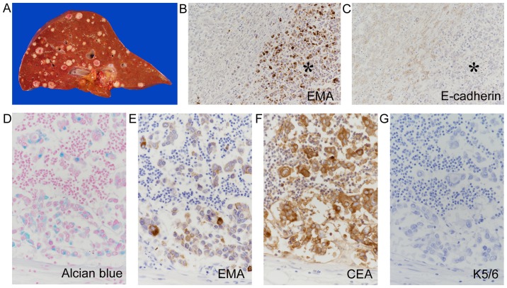 Esophageal Adenosquamous Carcinoma Mimicking Acantholytic Squamous Cell 