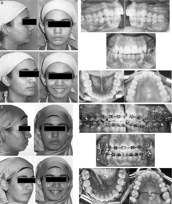 Figure 6. Intraoral and extraoral photos of Forsus Fatigue Resistant Device and mini-implants (FMI) group patient before and after treatment.