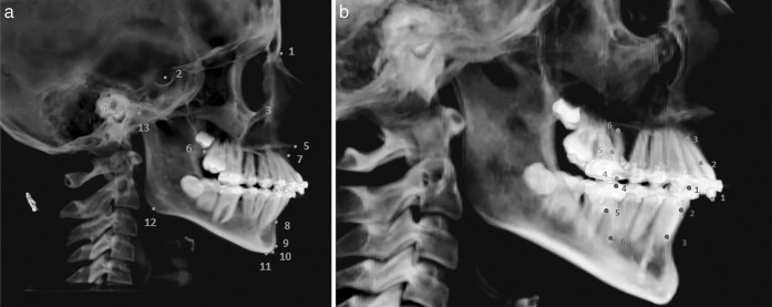 Figure 4. (a) Skeletal landmarks used in the study: 1, Nasion; 2, Sella Turcica; 3, Orbitale; 4, Porion; 5, Anterior nasal spine; 6, Posterior nasal spine; 7, A point; 8, B point; 9, Pogonion; 10, Gnathion; 11, Menton; 12, Gonion; and 13, Condylion. (b) 1, Incisal tip of crown of maxillary/mandibular incisor; 2, Midroot of maxillary/mandibular incisor; 3, Root apex of maxillary/mandibular incisor; 4, Mesiobuccal cusp of maxillary/mandibular first molars; 5, Furcation point of maxillary/mandibular first molars; and 6, Mesiobuccal root apex of maxillary/mandibular first molars.