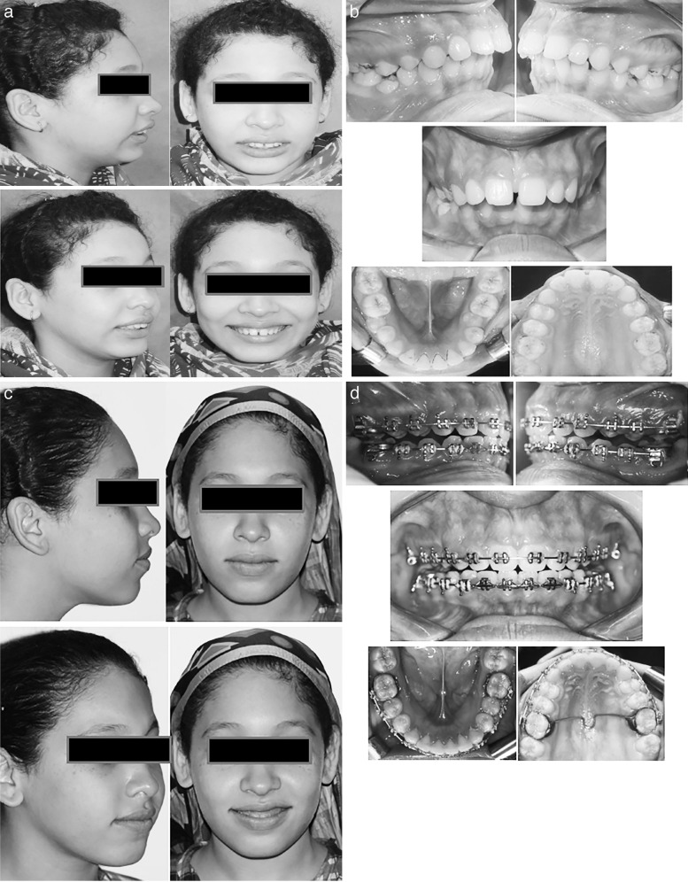 Figure 5. Intraoral and extraoral photos of a Forsus group patient before and after treatment.