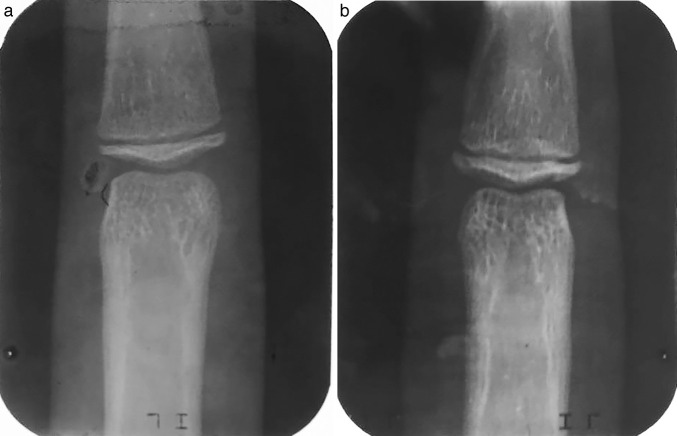 Figure 1. Periapical radiographs showing MP3 stages G (a) and H (b).