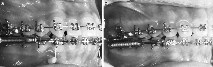 Figure 3. Forsus Fatigue Resistant Device (FFRD) inserted in the FFRD and mini-implants (FMI) group (a) and Forsus group (b).