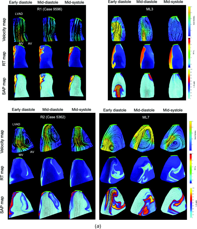 Clinical data [21] (R) and specific ML matching conditions at three cardiac instants (MV, AV, LVAD (pump inlet)). (a) Velocity maps, RT, and shear activation potential maps for the midplane area after 10 cycles of integration. (b) Time-varying vortex circulation (diastole starts at t = 0, second filling phase occurs at 55%, and systole starts at 70% of the cardiac cycle).