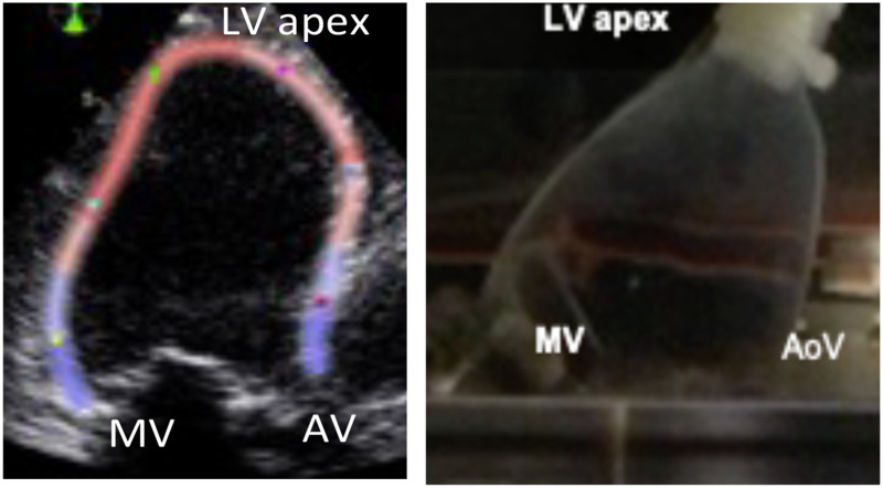 Apical long-axis three-chamber view (left) patient B-mode image (right) camera view of the ventricle bag