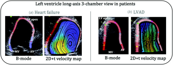 B-mode echocardiographic image and reconstruction velocity vector fields in the apical long-axis three-chamber view of (a) heart failure and (b) LVAD patients. (MV: mitral valve, AV: aortic valve, LV: left ventricle).