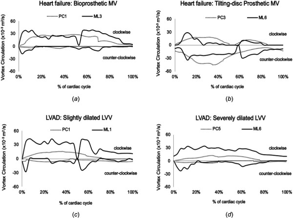 Time-varying clockwise and counterclockwise vortex circulations of heart failure and LVAD patients (PC) and ML studies (diastole starts at t = 0, second filling phase occurs at 55%, and systole starts at 70% of the cardiac cycle) (LVV: left ventricle volume)