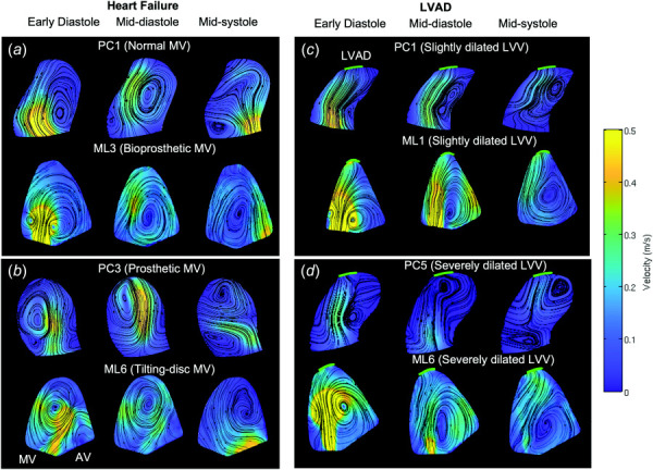 Intraventricular velocity fields of (a and b) heart failure and (c and d) LVAD patients (PC) and ML studies (MV: mitral valve, AV: aortic valve, LVAD: pump inlet, LVV: left ventricle volume)