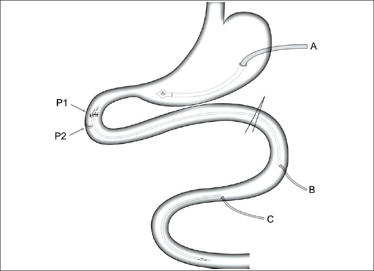 Duodenal perforation following blunt abdominal trauma - PMC