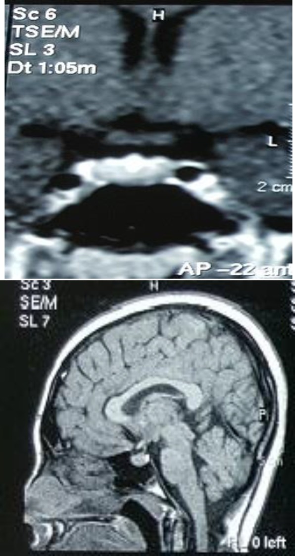 Pituitary macroadenoma resulting from primary hypothyroidism a 16 year