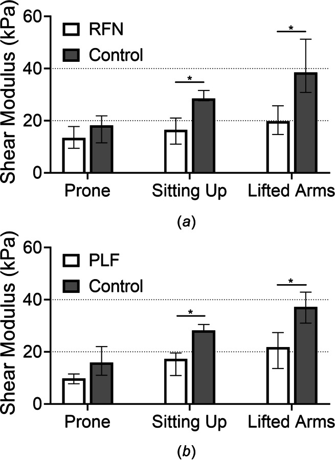 The shear modulus of the affected multifidus (median, interquartile range) was lower in the sitting up and sitting up with lifted arms positions in the RFN (a) and PLF (b) groups compared to age- and gender-matched healthy controls