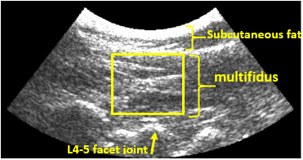 Representative B-mode ultrasound image of the multifidus in the prone position