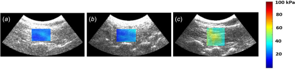 Representative shear modulus maps of the L4-5 multifidus muscle in the sitting up with the lifted arms position: PLF patient (a), RFN patient (b), and age- and gender-matched healthy participant (c). The lower shear modulus in the RFN and PLF patient compared to the healthy individual indicates multifidus dysfunction.