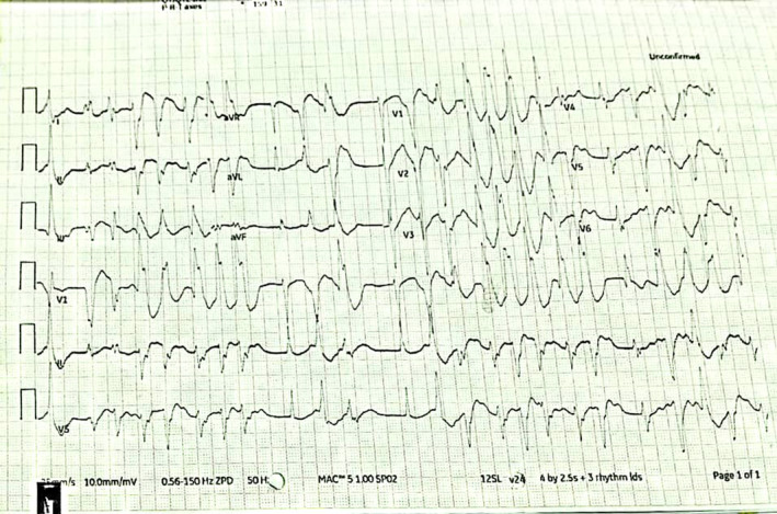 Accidental poisoning with aconite overdose: A case report and ...