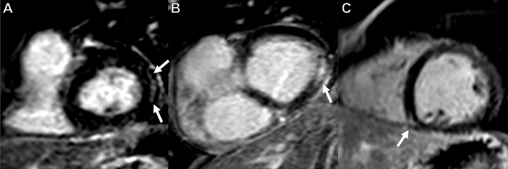 Late gadolinium enhancement (LGE) short-axis views demonstrate LGE in three of 41 patients (7%). Subepicardial LGE along the basal inferolateral wall (arrows) in (A) a 63-year-old man and (B) a 54-year-old man. (C) LGE at the right ventricular attachment (arrow) in a 19-year-old man.