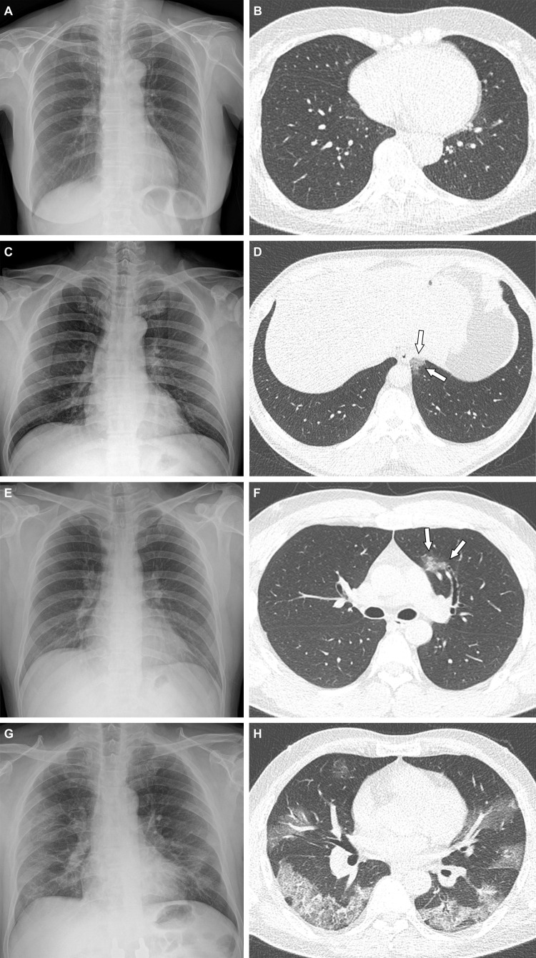 Representative cases showing pneumonia extents and patterns on chest radiographs and CT images. (A, B) Images in a 65-year-old woman with a breakthrough infection 2 months after a second dose of the BNT162b2 vaccine (fully vaccinated). The patient had a history of hypertension. (A) Chest radiograph obtained at admission shows no abnormal opacification in either lung. The chest radiograph extent of pneumonia was scored as 0 (no evidence of pneumonia). (B) Axial chest CT image at the lower lobe level (obtained on the same day) is negative for pneumonia; the extent of pneumonia at CT was scored as 0 (no evidence of pneumonia). (C, D) Images in a 48-year-old man 1 month after a first dose of the ChAdOx1 nCoV-19 vaccine (partially vaccinated). The patient had no history of comorbidity. (C) Chest radiograph obtained at admission shows no abnormal opacification in either lung. The chest radiograph extent of pneumonia was scored as 0 (no evidence of pneumonia). (D) Axial chest CT image obtained on the same day shows unilateral ground-glass opacity with a nonrounded morphologic feature in the left lower lobe (arrows). The extent of pneumonia at CT was scored as 1 (1%–25% involvement) and this case was classified as an indeterminate appearance of COVID-19 according to the RSNA chest CT classification system. (E, F) Images in a 36-year-old man with no history of vaccination for COVID-19 and no history of comorbidity. (E) Chest radiograph obtained at admission shows no abnormal opacification in either lung. The chest radiograph extent of pneumonia was scored as 0 (no evidence of pneumonia). (F) Axial chest CT image obtained on the same day shows unilateral ground-glass opacity with a nonrounded morphologic feature and nonperipheral distribution in the left upper lobe (arrows). The extent of pneumonia at CT was scored as 1 (1%–25% involvement), and this case was classified as an indeterminate appearance of COVID-19 according to the RSNA chest CT classification system. (G, H) Images in a 58-year-old man with no history of COVID-19 vaccination and a history of hypertension and diabetes. He required supplemental oxygen on admission and was admitted to the intensive care unit 1 day later. (G) Chest radiograph at admission shows patchy ground-glass opacities in the middle to lower zones of both lungs. The chest radiograph extent of pneumonia was scored as 2 (>25% involvement). (H) Axial chest CT image obtained on the same day shows multifocal ground-glass opacities with a crazy-paving appearance in bilateral lungs. The extent of pneumonia at CT was scored as 2 (>25% involvement) and was classified as a typical appearance of COVID-19 according to the RSNA chest CT classification system.