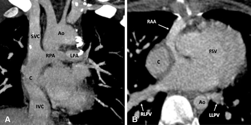 Postoperative appearance of DORV with functional single ventricle after extracardiac Fontan procedure in an 8-year-old girl. (A) Coronal oblique maximum intensity projection (MIP) CT image shows the superior and inferior connection of the conduit to the RPA and IVC, respectively. The SVC is connected to the RPA. No evidence of any conduit stenosis, calcification, or thrombosis is seen. (B) Axial MIP CT image shows an extra-atrial conduit placed entirely outside the right atrium. Ao = aorta, C = conduit, DORV = double-outlet right ventricle, FSV = functional single ventricle, IVC = inferior vena cava, LLPV = left lower pulmonary vein, LPA = left pulmonary artery, RAA = right atrial appendage, RLPV = right lower pulmonary vein, RPA = right pulmonary artery, SVC = superior vena cava.