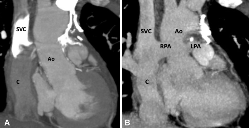 Extracardiac Fontan procedure biphasic acquisition protocol. (A) Coronal reformatted maximum intensity projection (MIP) CT image in the early arterial phase shows well-opacified aortic root. The Fontan circuit is not opacified, giving false impression of thrombosis. (B) Coronal reformatted MIP CT image in the late venous phase shows uniform opacification of the Fontan conduit. Ao = aorta, C = conduit, LPA = left pulmonary artery, RPA = right pulmonary artery, SVC = superior vena cava.