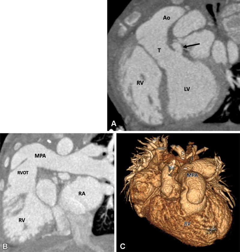 Postoperative appearance after réparation à l’etage ventriculaire (REV procedure) for treatment of dextrotransposition of the great arteries, ventricular septal defect, and pulmonary stenosis in a 26-year-old man. (A) Sagittal oblique maximum intensity projection (MIP) CT image shows a small pseudoaneurysm (black arrow) arising from the LV outflow tract. (B) Sagittal oblique MIP CT image shows mildly dilated RV and RVOT. (C) Volume-rendered image shows direct implantation of the MPA on the RV lying anterior to the aorta. The REV procedure is similar to Rastelli repair, except the pulmonary artery is directly connected with the RV, avoiding the RV-MPA conduit. Ao = aorta, LV = left ventricle, MPA = main pulmonary artery, RA = right atrium, RV = right ventricle, RVOT = right ventricular outflow tract, T = tunnel.