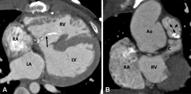 Postoperative appearance of truncus arteriosus after RV-PA conduit formation and VSD closure in an 11-year-old boy. (A) Axial contrast-enhanced CT image shows a calcified VSD patch bulging into the RV (black arrow). (B) Coronal oblique contrast-enhanced CT image shows the RV-PA conduit. The pulmonary valve leaflets show degenerative changes evident as leaflet calcifications (black arrows). Ao = aorta, C = conduit, LA = left atrium, LV = left ventricle, PA = pulmonary artery, RA = right atrium, RV = right ventricle, VSD = ventricular septal defect.