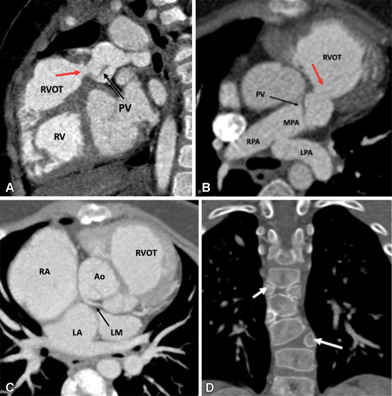 Postoperative appearance of TOF-type DORV after VSD closure with LV routing, infundibular resection, and patch augmentation of the RVOT up to the main pulmonary artery in a 4-month-old male infant. (A) Sagittal oblique and (B) axial multiplanar reconstruction CT images show dilated RV and RVOT. There is residual subvalvular narrowing (red arrow). The residual pulmonary valve tissue is shown with a black arrow. The MPA, RPA, and LPA appear normal. (C) Axial maximum intensity projection (MIP) CT image shows anomalous origin of the left main coronary artery (black arrow) from the noncoronary sinus with retroaortic course. (D) Coronal reformatted MIP CT image shows multiple hemivertebrae (white arrows). Ao = aorta, DORV = double-outlet right ventricle, LA = left atrium, LM = left main, LPA = left pulmonary artery, LV = left ventricle, MPA = main pulmonary artery, PV = pulmonary valve, RA = right atrium, RPA = right pulmonary artery, RV = right ventricle, RVOT = right ventricular outflow tract, TOF = tetralogy of Fallot, VSD = ventricular septal defect.