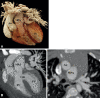 Preoperative appearance of TGA-type DORV in a 2-month-old female
infant. (A) Cinematic rendering technique image shows both the great
arteries arising from the right ventricle. Both the great vessel trunks run
parallel to each other, with the aorta on the right side. (B) Coronal
reformatted maximum intensity projection (MIP) CT image shows a subpulmonic
VSD. (C) Axial MIP CT image shows the great vessels relationship. The aorta
is seen anterior and to the right of the MPA, suggesting dextrotransposition
(D-TGA type) relationship. Ao = aorta, DORV = double-outlet right ventricle,
LV = left ventricle, MPA = main pulmonary artery, RV = right ventricle, TGA
= transposition of the great arteries, VSD = ventricular septal
defect.