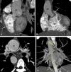Preoperative appearance of tetralogy of Fallot with pulmonary atresia in a
male infant. (A) Sagittal oblique maximum intensity projection (MIP) CT image
shows right ventricular hypertrophy (white arrow), VSD (black double arrow), and
overriding of the aorta. MPA is not visualized. (B) Coronal oblique MIP CT image
shows pulmonary atresia (white arrow). (C) Axial oblique MIP CT image shows
severe hypoplasia of the branch pulmonary arteries. MPA is absent. Thin but
confluent branch pulmonary arteries produce the typical “seagull
wing” appearance. White arrows indicate RPA and LPA. (D) Coronal oblique
MIP CT image shows multiple MAPCAs arising from the descending thoracic aorta
(yellow arrows) and upper abdominal aorta (green arrows). Ao = aorta, LPA = left
pulmonary artery, LV = left ventricle, MAPCA = major aortopulmonary collateral
artery, MPA = main pulmonary artery, RPA = right pulmonary artery, RV = right
ventricle, VSD = ventricular septal defect.