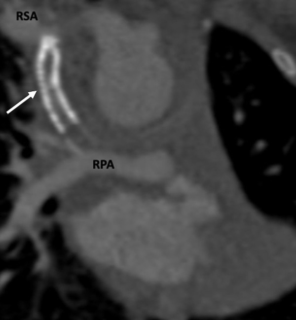 Postprocedural appearance of tetralogy of Fallot after modified BT shunt at birth followed by stent placement in a 3-month-old female infant. Coronal oblique contrast-enhanced CT image shows a stent (white arrow) in the modified BT shunt, which was made between the RSA and RPA at birth. The stent was placed to relieve stenosis of the BT shunt. The stent appears thrombosed and shows severe stenosis at the subclavian end. BT = Blalock-Taussig, RPA = right pulmonary artery, RSA = right subclavian artery.