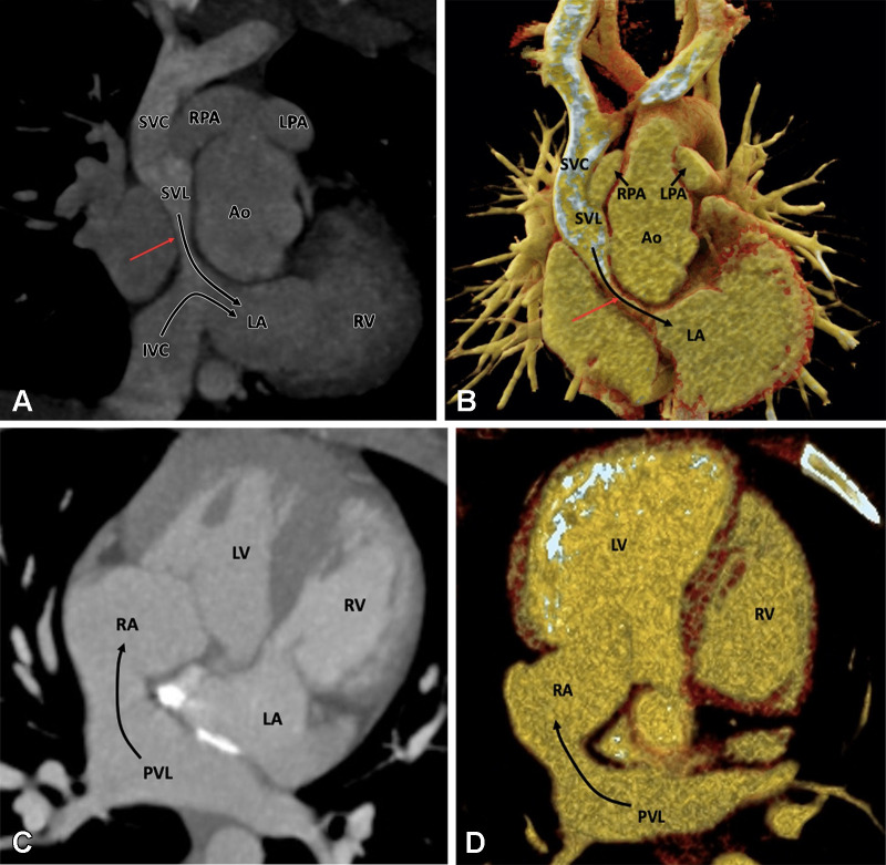 Postoperative appearance of levotransposition of the great arteries after double-switch operation (Senning procedure and arterial switch) in an 8-year-old boy. (A) Coronal oblique maximum intensity projection (MIP) CT image and (B) coronal oblique cut volume-rendered image show the systemic venous limb of the baffle emptying systemic venous blood into the left atrium and morphologic right ventricle (long curved black arrows). There is evidence of severe stenosis in the systemic venous limb (red arrow). Also, note the right and left pulmonary arteries (short straight black arrows in B) lying on either side of the aorta as the normal postoperative appearance of LeCompte maneuver. (C) Axial MIP CT image and (D) axial cut volume-rendered images show the pulmonary venous limb of the baffle emptying pulmonary venous blood into the right atrium and morphologic left ventricle (long curved black arrow). Ao = aorta, IVC = inferior vena cava, LA = left atrium, LPA = left pulmonary artery, LV = left ventricle, PVL = pulmonary venous limb, RPA = right pulmonary artery, RA = right atrium, RV = right ventricle, SVC = superior vena cava, SVL = systemic venous limb.