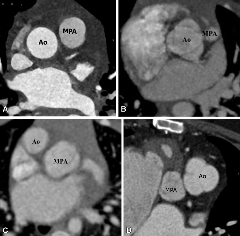 Great vessels relationship. (A) Normal great vessels relationship in a 25-year-old healthy man. Axial contrast-enhanced CT image shows the ascending aorta is in a position posterior and to the right of the pulmonary artery. (B) Normal relationship in a 2-year-old boy with TOF-type DORV. Axial maximum intensity projection (MIP) CT image shows the ascending aorta in a position posterior and to the right of the pulmonary artery. Pulmonary stenosis is observed, which is a common feature of TOF-type DORV. (C) Dextrotransposition in a 1.5-year-old girl with TGA-type DORV. Axial MIP CT image shows the ascending aorta in a position anterior and to the right of the MPA. (D) Levotransposition in a 2-year-old girl with TGA-type DORV. Axial MIP CT image shows the ascending aorta in a position anterior and to the left of the pulmonary artery. Ao = aorta, DORV = double-outlet right ventricle, MPA = main pulmonary artery, TGA = transposition of the great arteries, TOF = tetralogy of Fallot.