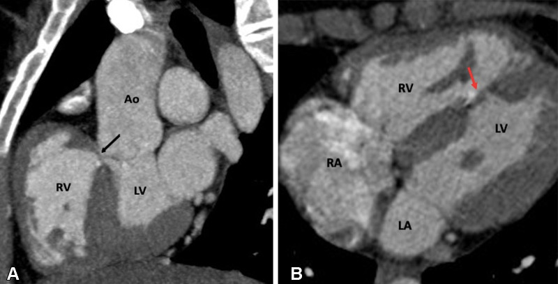 Postoperative appearance of tetralogy of Fallot after total correction in a 12-year-old boy. (A) Sagittal oblique and (B) axial maximum intensity projection CT images show perimembranous (black arrow in A) and mid muscular (red arrow in B) VSD patches. Ao = aorta, LA = left atrium, LV = left ventricle, RA = right atrium, RV = right ventricle, VSD = ventricular septal defect.